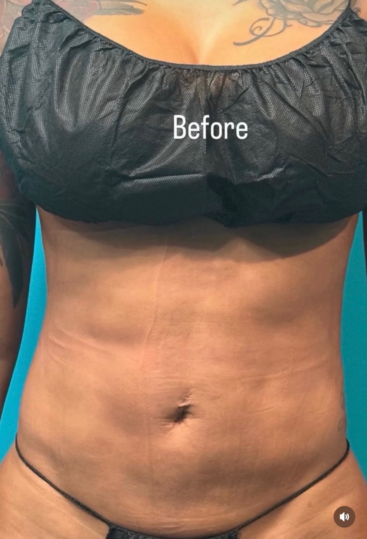 Body contouring result 2
