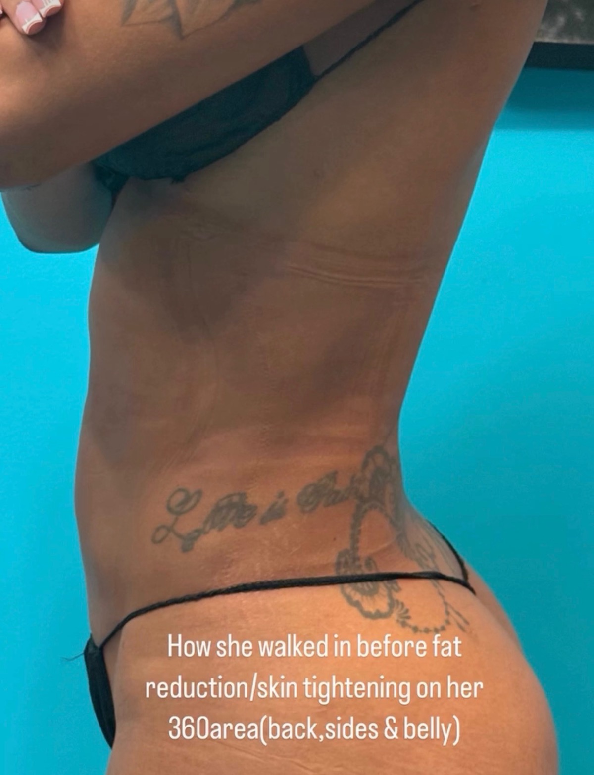 Body contouring result 3