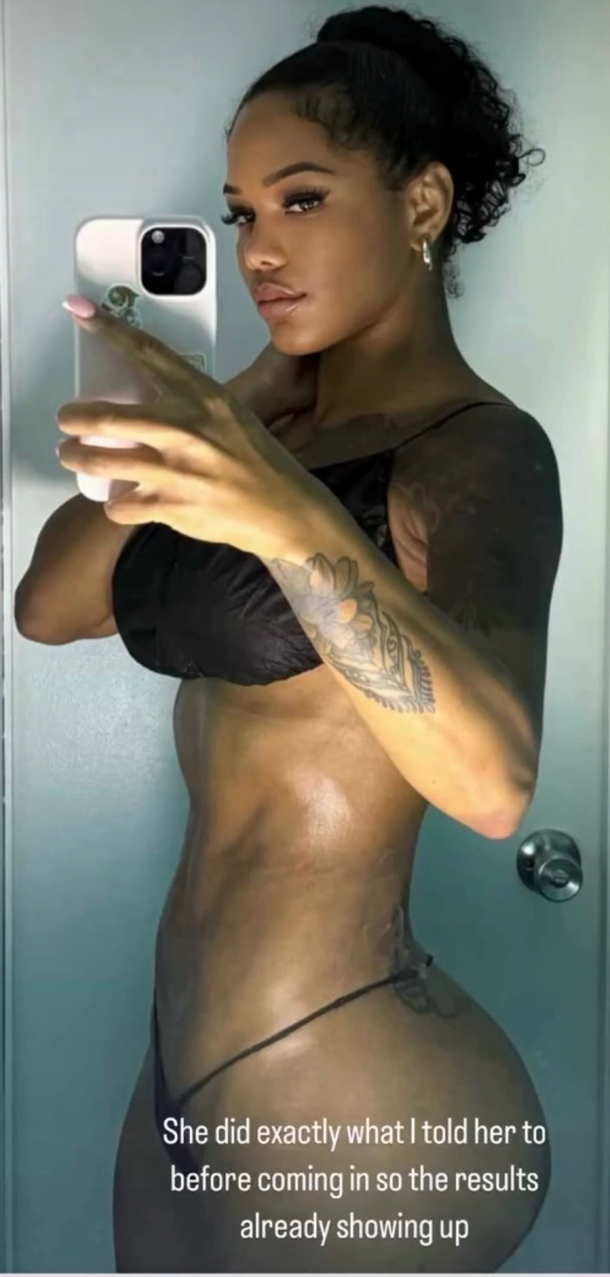 Body contouring result 4