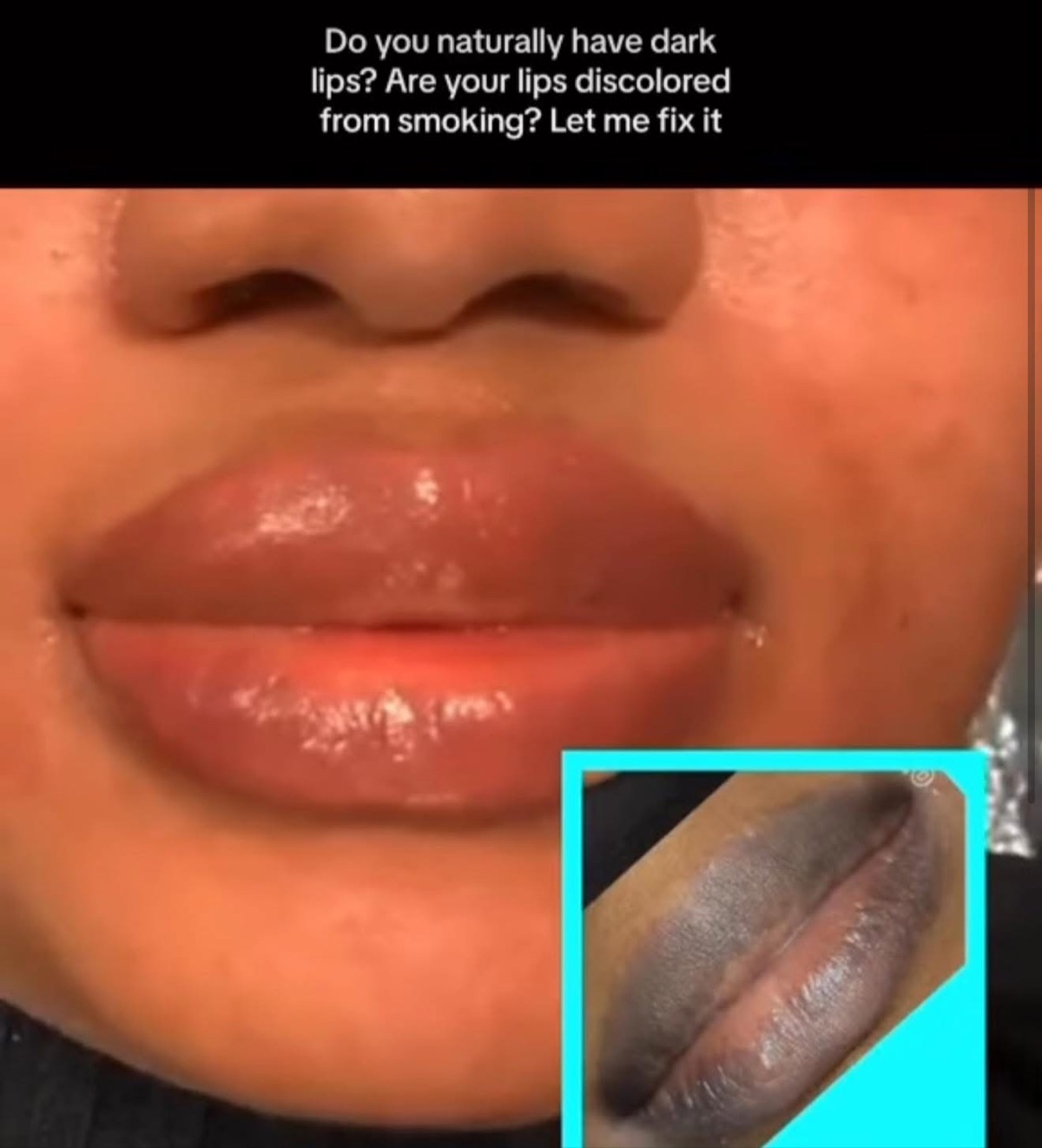 Lip neutralization before and after