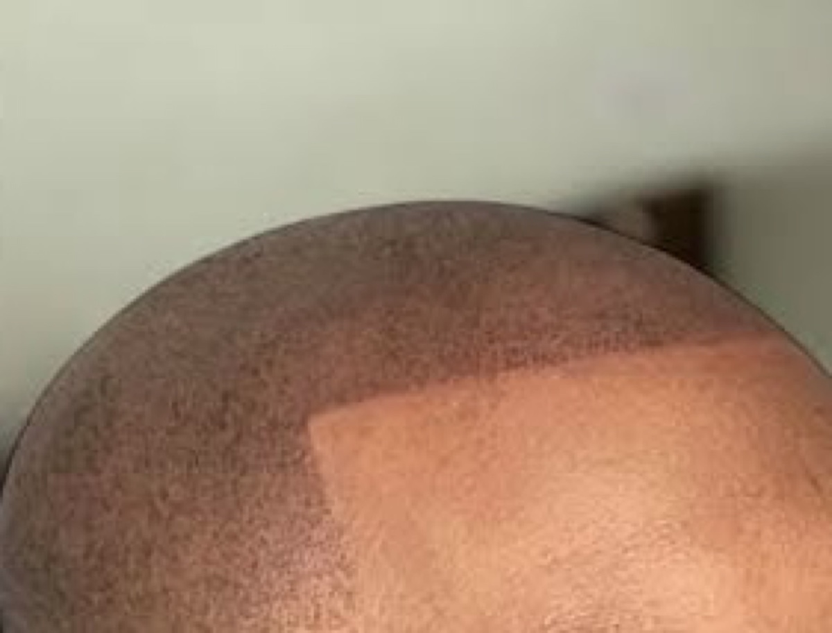 SMP scalp care